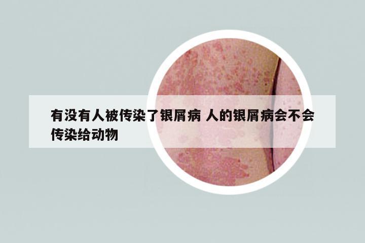 有沒有人被傳染了銀屑病 人的銀屑病會(huì)不會(huì)傳染給動(dòng)物