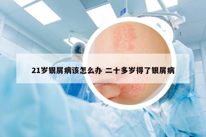 21歲銀屑病該怎么辦 二十多歲得了銀屑病