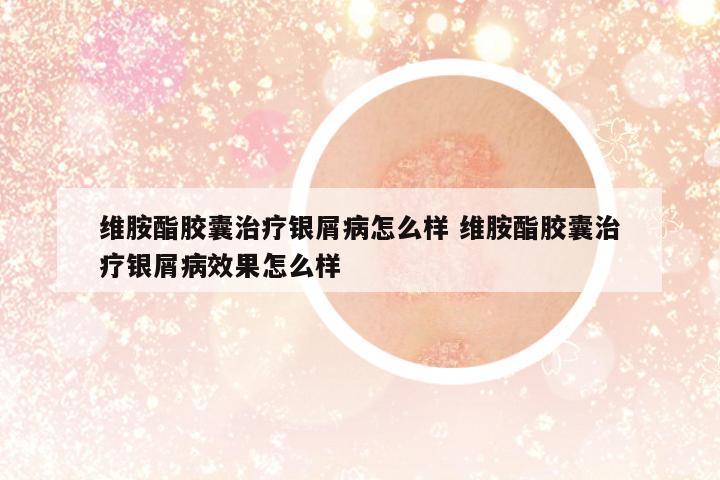 維胺酯膠囊治療銀屑病怎么樣 維胺酯膠囊治療銀屑病效果怎么樣