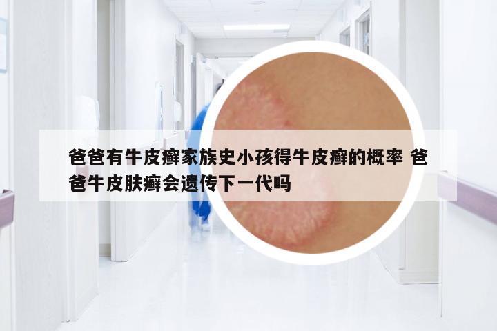 爸爸有牛皮癬家族史小孩得牛皮癬的概率 爸爸牛皮膚癬會(huì)遺傳下一代嗎