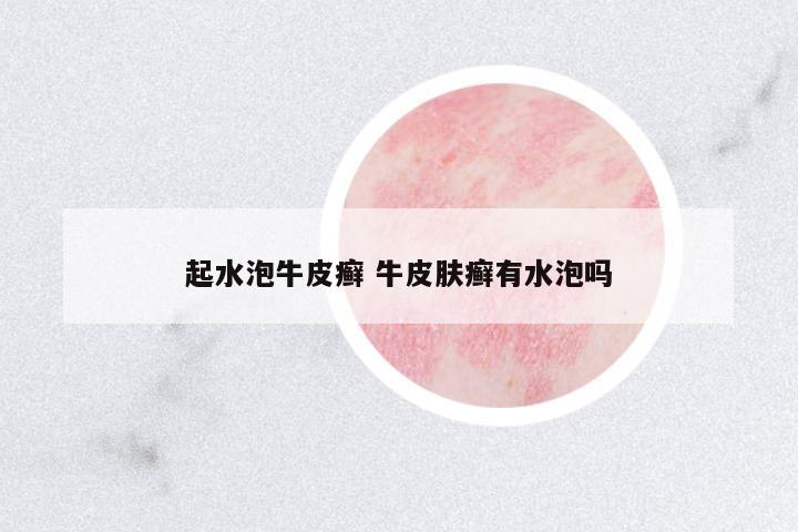 起水泡牛皮癬 牛皮膚癬有水泡嗎
