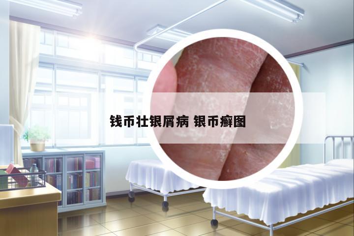 錢幣壯銀屑病 銀幣癬圖
