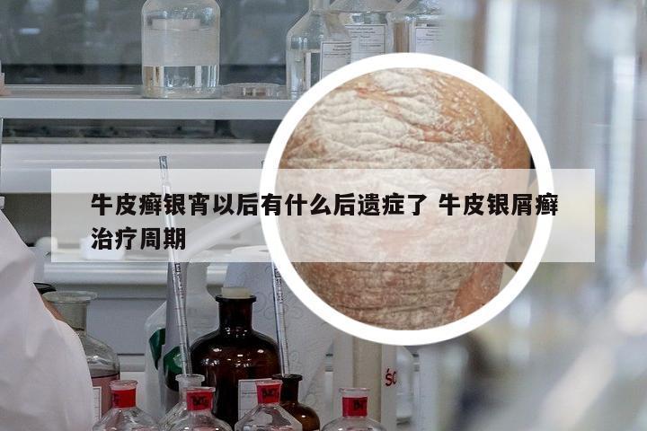 牛皮癬銀宵以后有什么后遺癥了 牛皮銀屑癬治療周期