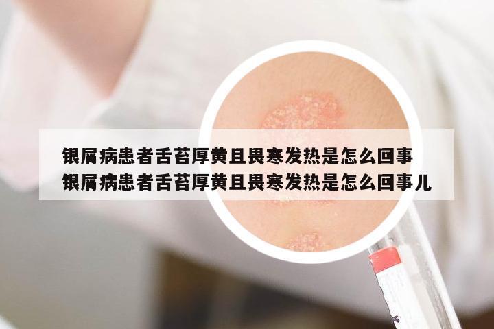 銀屑病患者舌苔厚黃且畏寒發(fā)熱是怎么回事 銀屑病患者舌苔厚黃且畏寒發(fā)熱是怎么回事兒