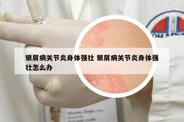 銀屑病關(guān)節(jié)炎身體強(qiáng)壯 銀屑病關(guān)節(jié)炎身體強(qiáng)壯怎么辦