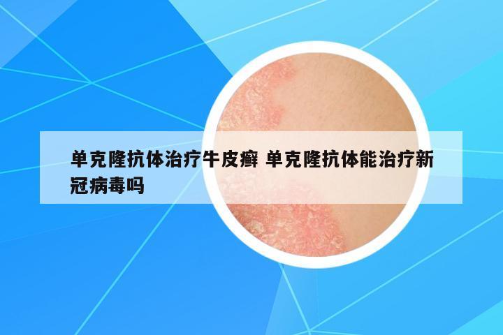單克隆抗體治療牛皮癬 單克隆抗體能治療新冠病毒嗎