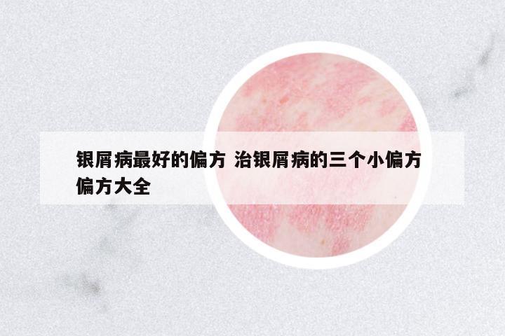 銀屑病最好的偏方 治銀屑病的三個小偏方 偏方大全