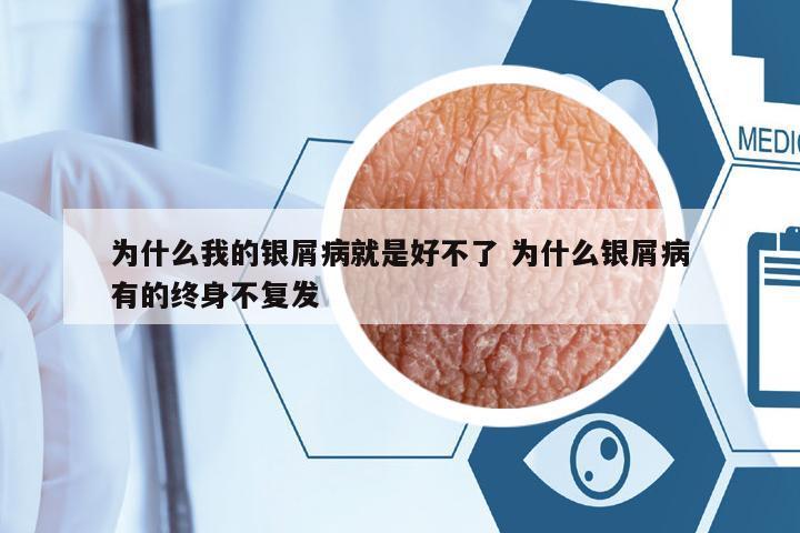 為什么我的銀屑病就是好不了 為什么銀屑病有的終身不復(fù)發(fā)