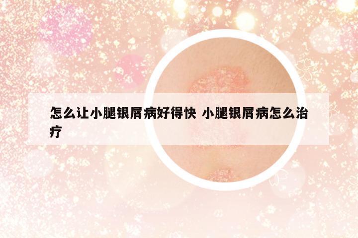 怎么讓小腿銀屑病好得快 小腿銀屑病怎么治療