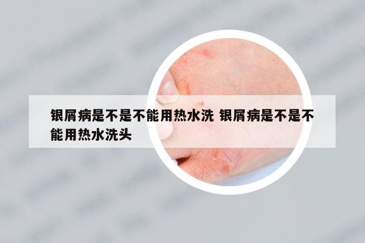 銀屑病是不是不能用熱水洗 銀屑病是不是不能用熱水洗頭