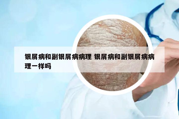 銀屑病和副銀屑病病理 銀屑病和副銀屑病病理一樣嗎