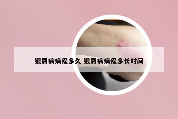 銀屑病病程多久 銀屑病病程多長時間