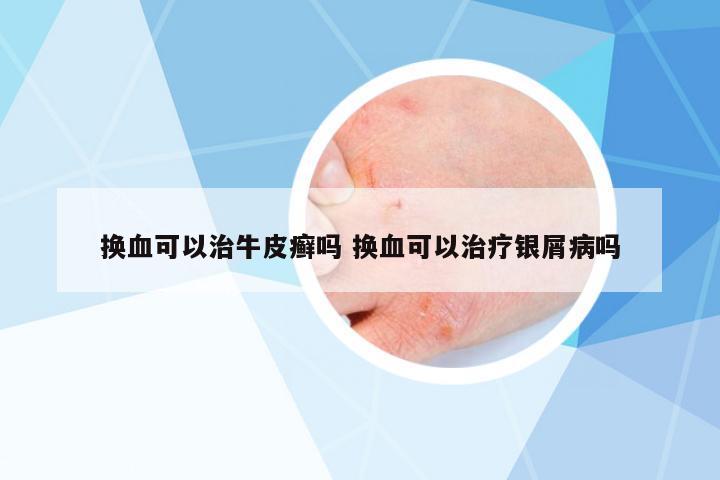 換血可以治牛皮癬嗎 換血可以治療銀屑病嗎