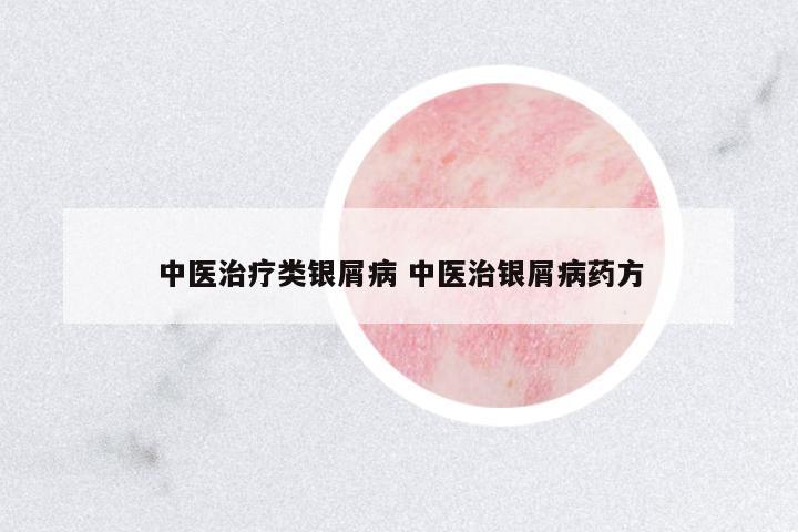 中醫(yī)治療類銀屑病 中醫(yī)治銀屑病藥方