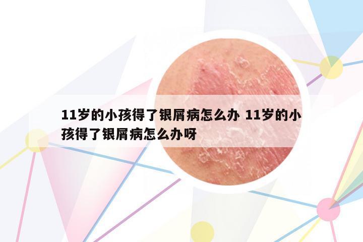 11歲的小孩得了銀屑病怎么辦 11歲的小孩得了銀屑病怎么辦呀