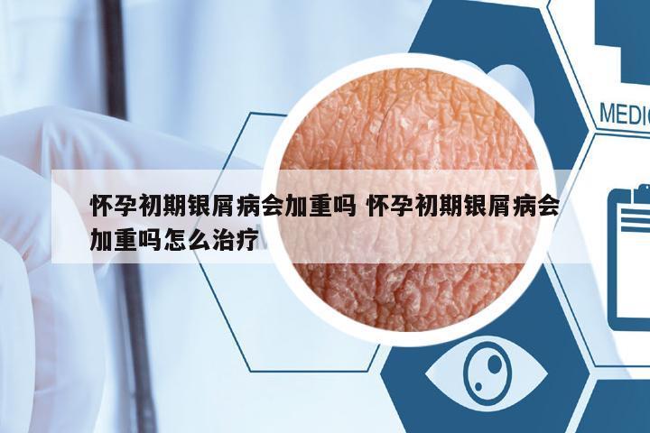 懷孕初期銀屑病會加重嗎 懷孕初期銀屑病會加重嗎怎么治療