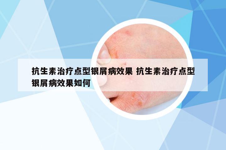 抗生素治療點型銀屑病效果 抗生素治療點型銀屑病效果如何