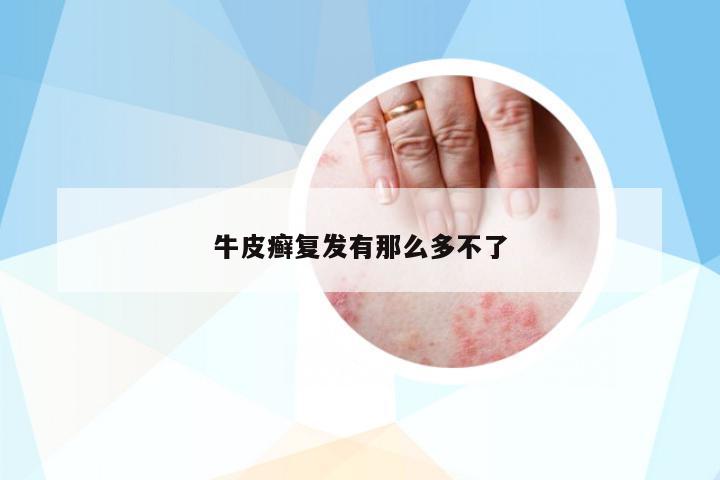 牛皮癬復(fù)發(fā)有那么多不了