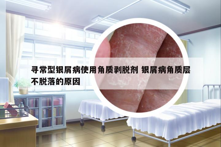 尋常型銀屑病使用角質(zhì)剝脫劑 銀屑病角質(zhì)層不脫落的原因