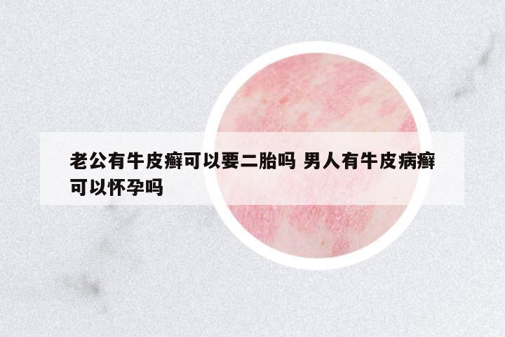 老公有牛皮癬可以要二胎嗎 男人有牛皮病癬可以懷孕嗎