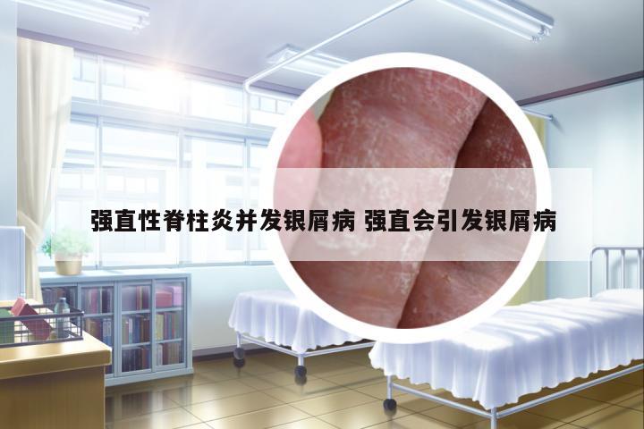 強直性脊柱炎并發(fā)銀屑病 強直會引發(fā)銀屑病