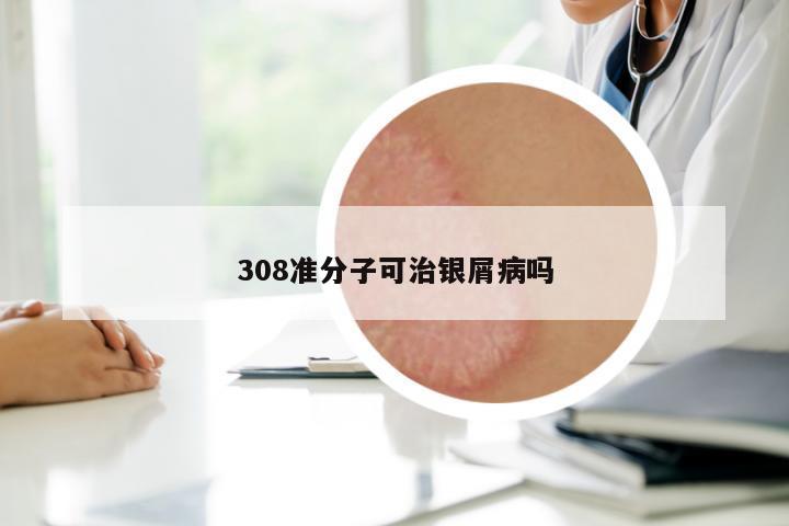 308準分子可治銀屑病嗎