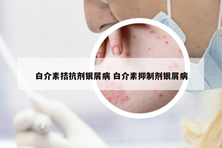 白介素拮抗劑銀屑病 白介素抑制劑銀屑病