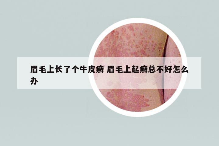 眉毛上長了個(gè)牛皮癬 眉毛上起癬總不好怎么辦
