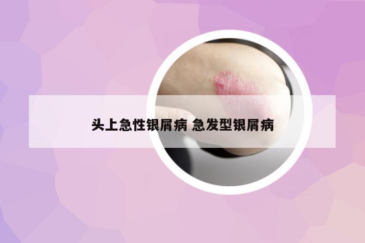 頭上急性銀屑病 急發(fā)型銀屑病