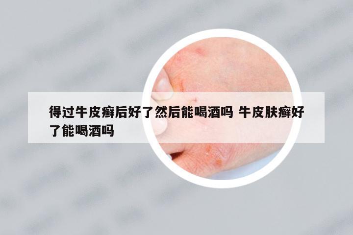 得過牛皮癬后好了然后能喝酒嗎 牛皮膚癬好了能喝酒嗎