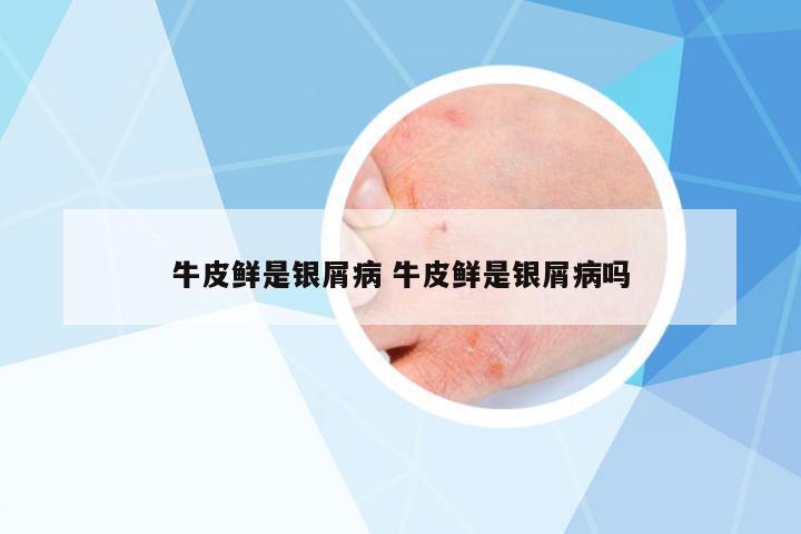 牛皮鮮是銀屑病 牛皮鮮是銀屑病嗎