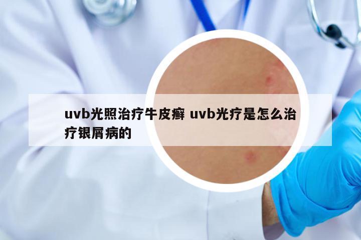 uvb光照治療牛皮癬 uvb光療是怎么治療銀屑病的