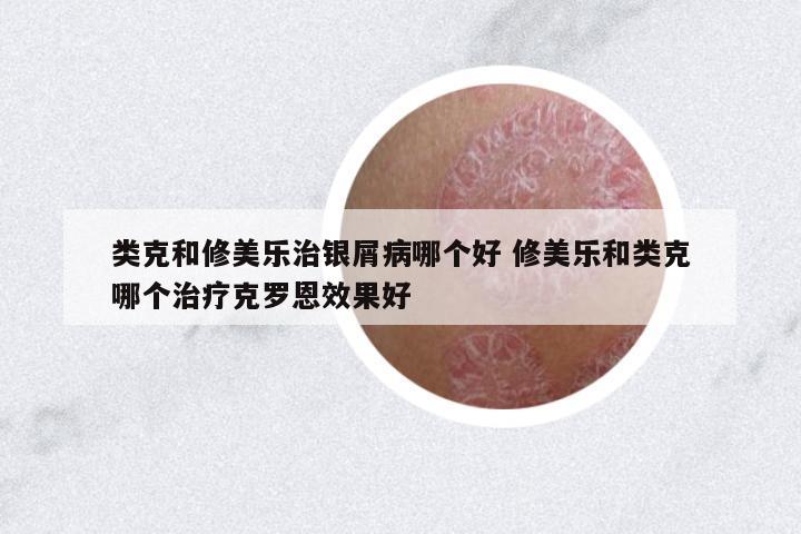 類(lèi)克和修美樂(lè)治銀屑病哪個(gè)好 修美樂(lè)和類(lèi)克哪個(gè)治療克羅恩效果好