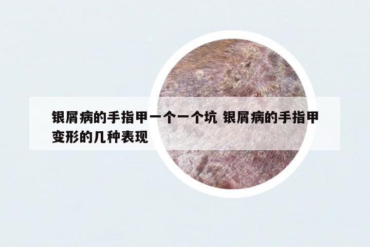 銀屑病的手指甲一個一個坑 銀屑病的手指甲變形的幾種表現(xiàn)