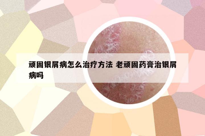 頑固銀屑病怎么治療方法 老頑固藥膏治銀屑病嗎