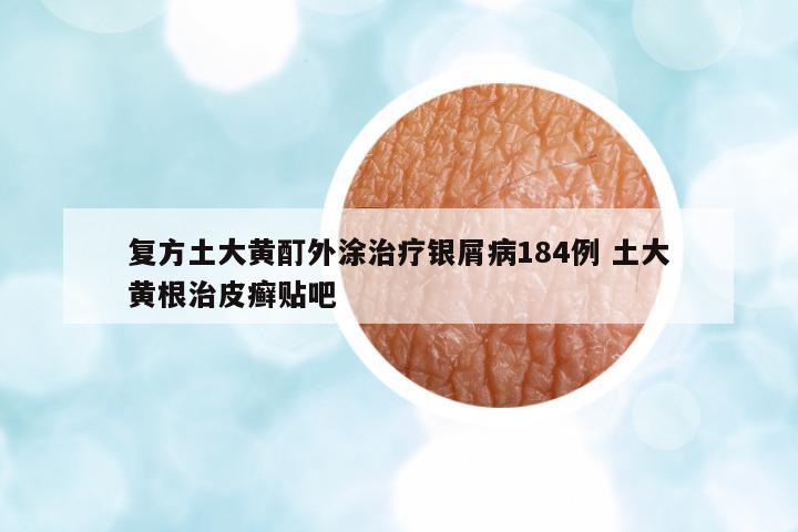 復(fù)方土大黃酊外涂治療銀屑病184例 土大黃根治皮癬貼吧