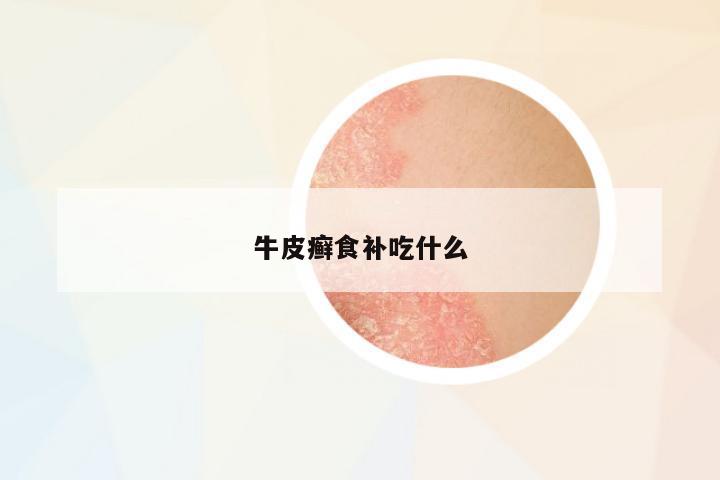 牛皮癬食補(bǔ)吃什么