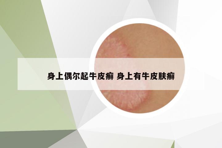 身上偶爾起牛皮癬 身上有牛皮膚癬