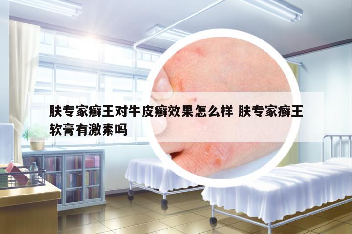 膚專家癬王對牛皮癬效果怎么樣 膚專家癬王軟膏有激素嗎