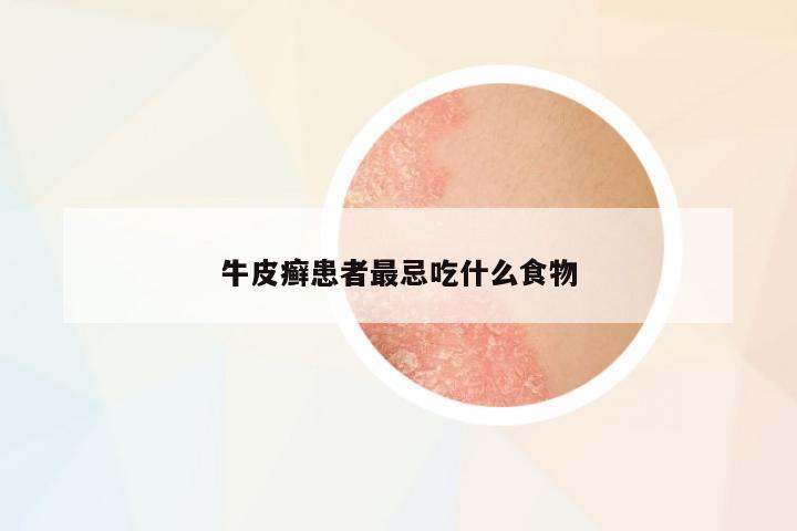 牛皮癬患者最忌吃什么食物