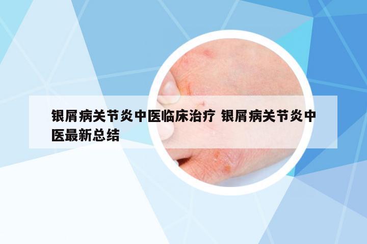 銀屑病關(guān)節(jié)炎中醫(yī)臨床治療 銀屑病關(guān)節(jié)炎中醫(yī)最新總結(jié)