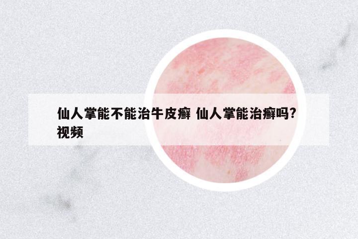 仙人掌能不能治牛皮癬 仙人掌能治癬嗎? 視頻