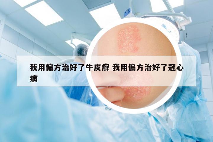 我用偏方治好了牛皮癬 我用偏方治好了冠心病