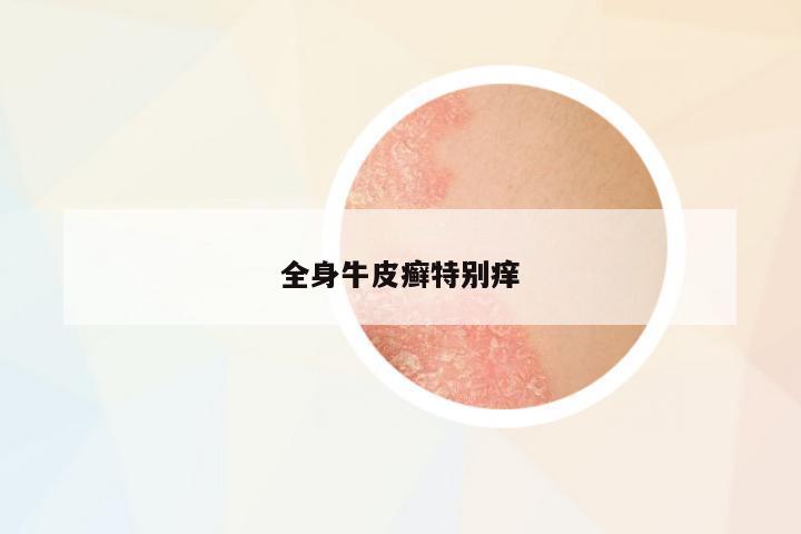 全身牛皮癬特別癢