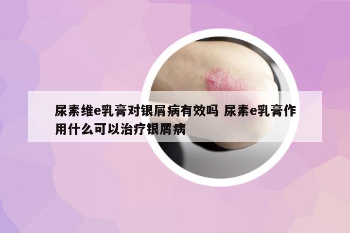 尿素維e乳膏對銀屑病有效嗎 尿素e乳膏作用什么可以治療銀屑病
