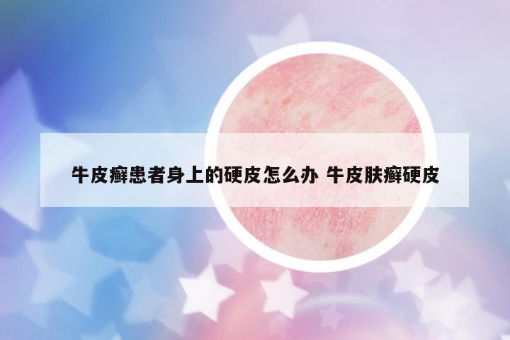 牛皮癬患者身上的硬皮怎么辦 牛皮膚癬硬皮