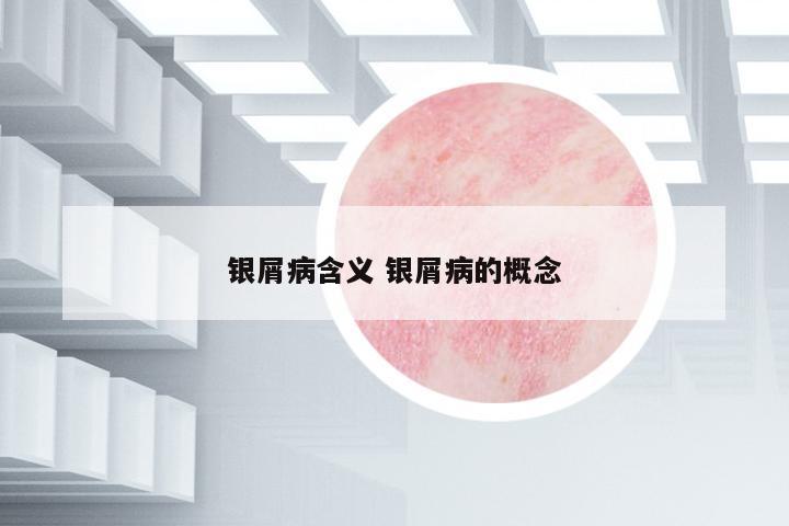 銀屑病含義 銀屑病的概念