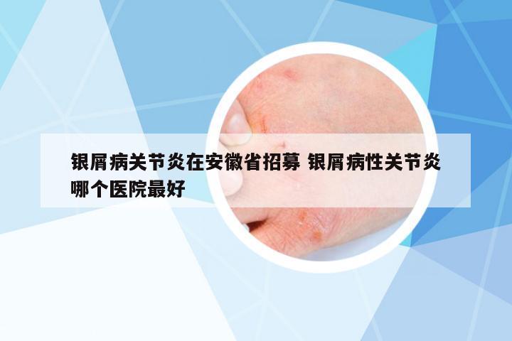 銀屑病關(guān)節(jié)炎在安徽省招募 銀屑病性關(guān)節(jié)炎哪個(gè)醫(yī)院最好