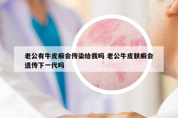 老公有牛皮癬會傳染給我嗎 老公牛皮膚癬會遺傳下一代嗎