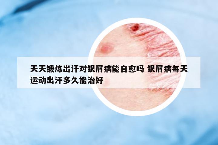天天鍛煉出汗對銀屑病能自愈嗎 銀屑病每天運動出汗多久能治好